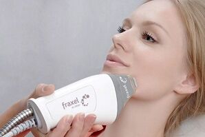 inti dari prosedur peremajaan kulit wajah fraksional