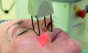 melakukan prosedur peremajaan laser fraksional